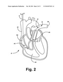 PRESSURE MONITORING TO CONTROL DELIVERY OF THERAPEUTIC AGENT diagram and image