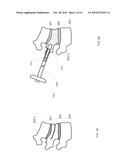 Minimally Invasive Cement Delivery System Retainer diagram and image