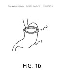 ARTIFICIAL GASTRIC VALVE diagram and image