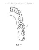 ARTIFICIAL GASTRIC VALVE diagram and image