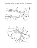 BAROREFLEX ACTIVATION THERAPY WITH CONDITIONAL SHUT OFF diagram and image