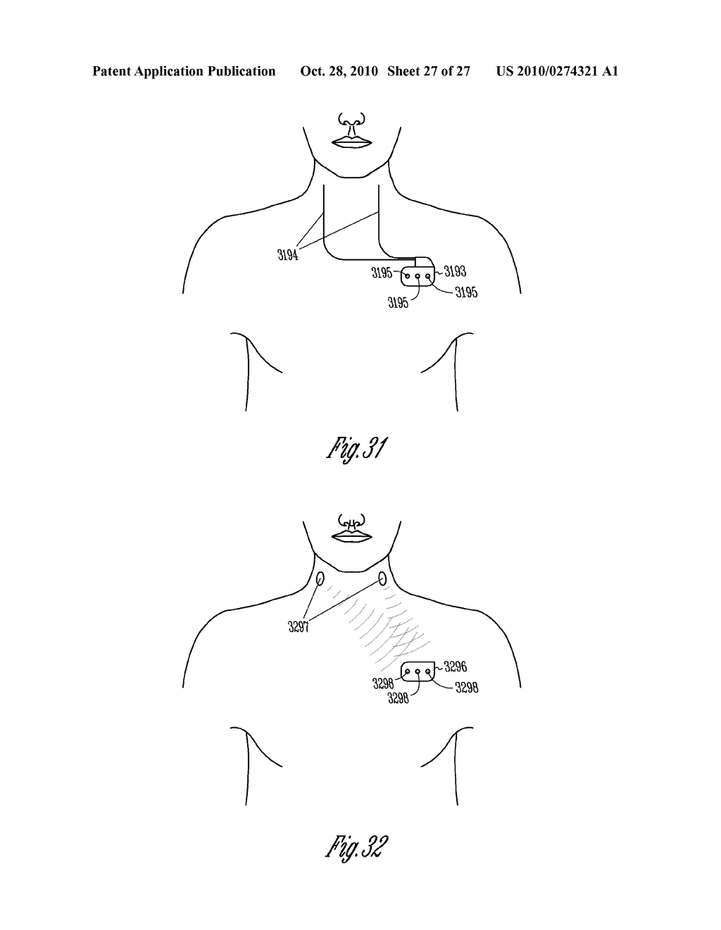 BAROREFLEX ACTIVATION THERAPY WITH CONDITIONAL SHUT OFF - diagram, schematic, and image 28