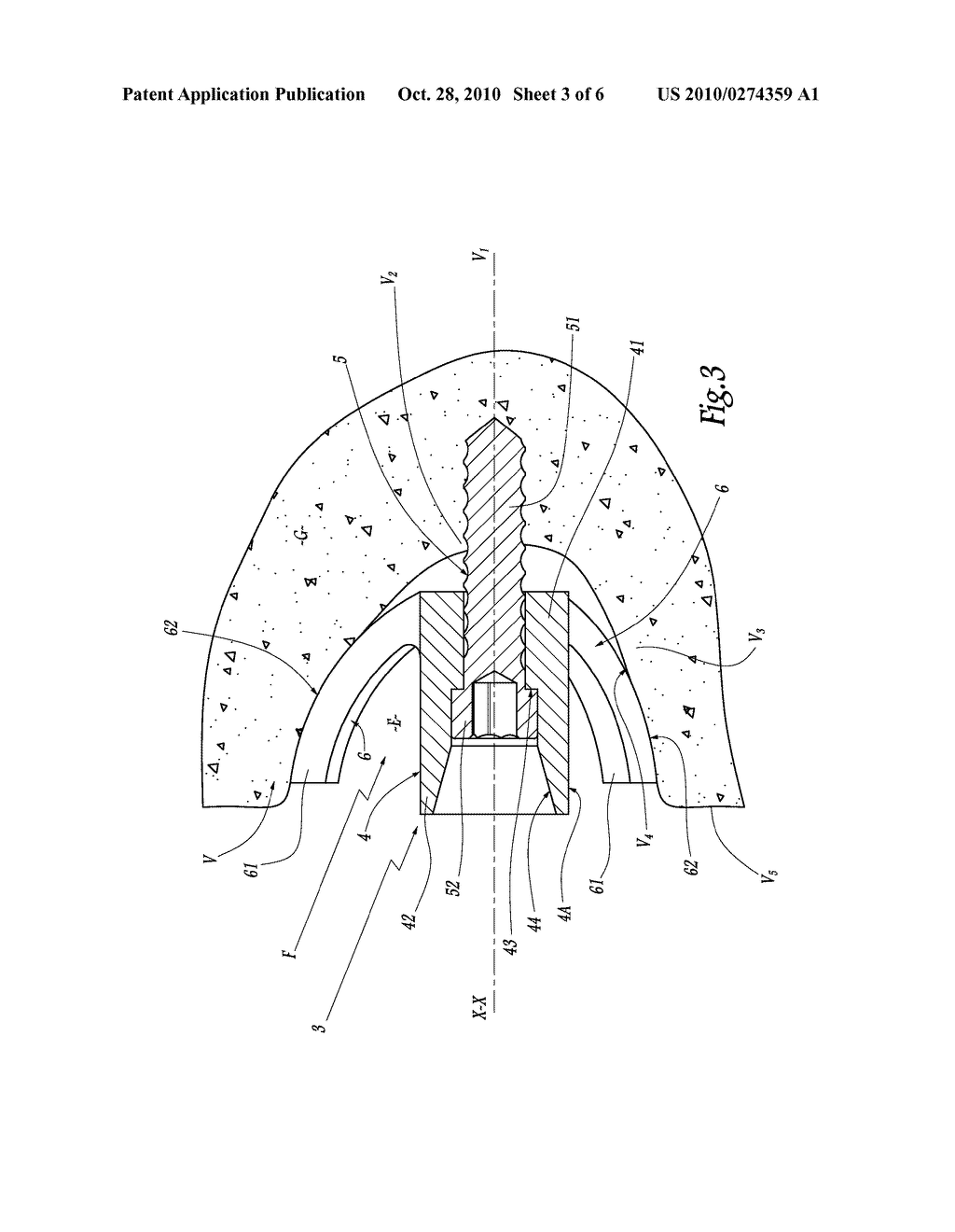 JOINT PROSTHESIS ATTACHMENT SYSTEM, DEVICE AND METHOD - diagram, schematic, and image 04