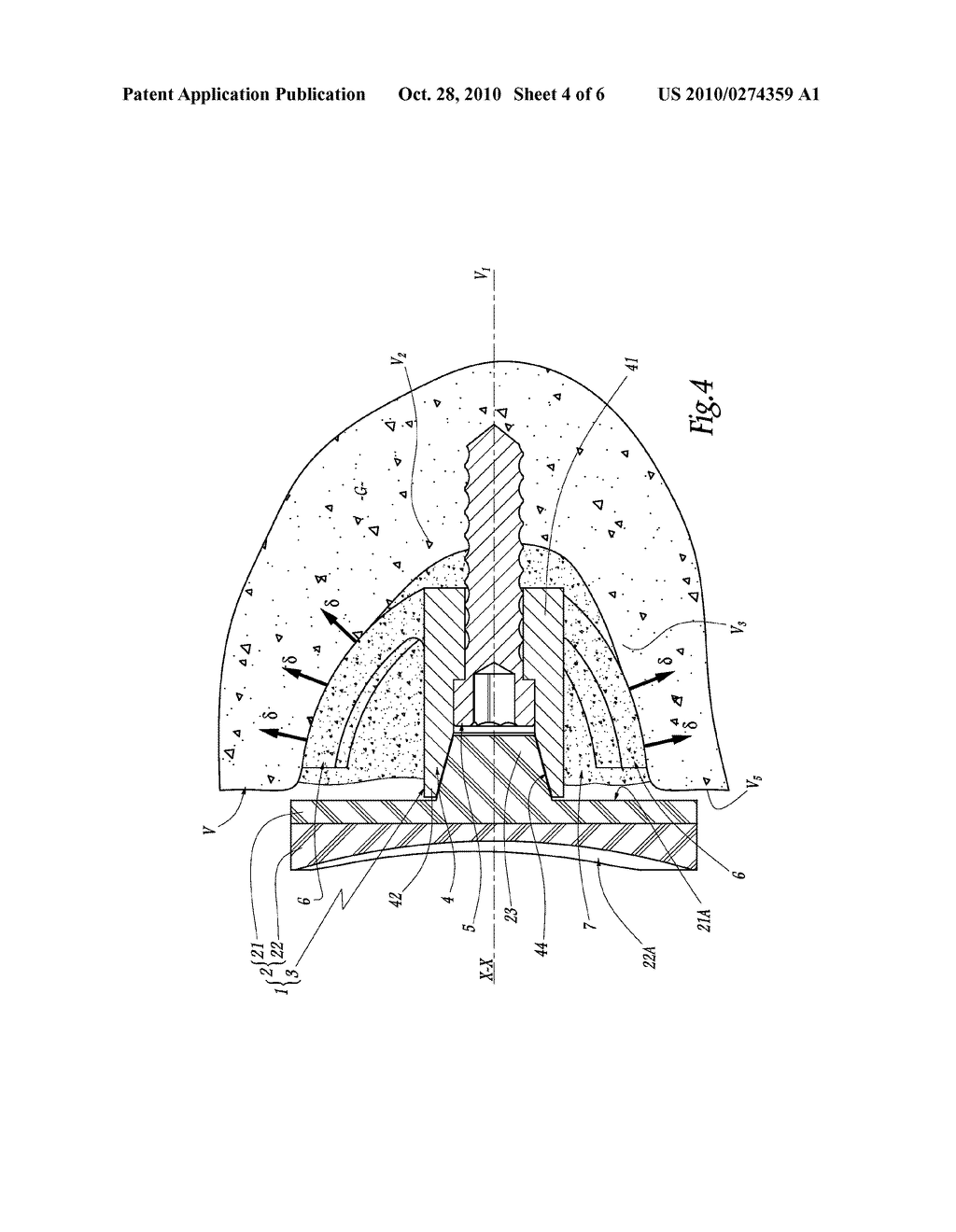 JOINT PROSTHESIS ATTACHMENT SYSTEM, DEVICE AND METHOD - diagram, schematic, and image 05