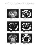 Scoring Method for Imaging-Based Detection of Vulnerable Patients diagram and image