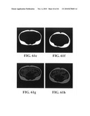 Scoring Method for Imaging-Based Detection of Vulnerable Patients diagram and image