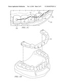 Removable Orthodontic Appliance and Method of Forming the Same diagram and image