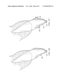 Removable Orthodontic Appliance and Method of Forming the Same diagram and image