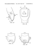 Removable Orthodontic Appliance and Method of Forming the Same diagram and image