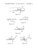 SYSTEMS AND METHODS FOR ENDOSCOPIC INVERSION AND REMOVAL OF DIVERTICULA diagram and image