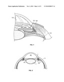 OCULAR IMPLANT DELIVERY SYSTEMS AND METHODS diagram and image