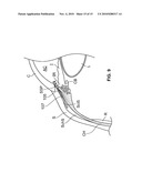 OCULAR IMPLANT DELIVERY SYSTEMS AND METHODS diagram and image