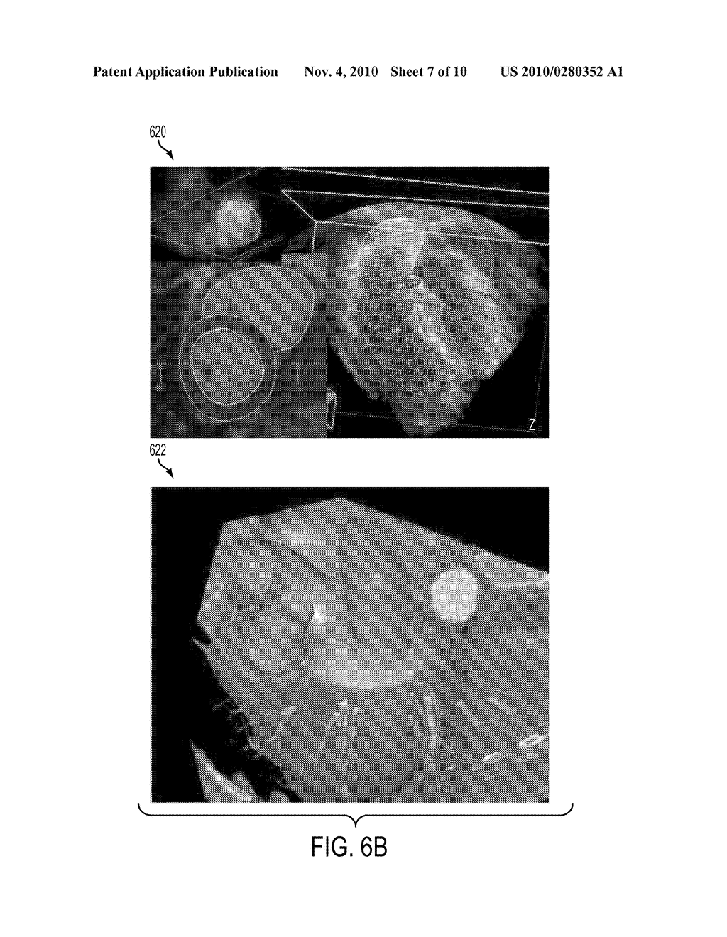 Method and System for Multi-Component Heart and Aorta Modeling for Decision Support in Cardiac Disease - diagram, schematic, and image 08