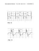 METHOD AND APPARATUS FOR IDENTIFYING CARDIAC AND NON-CARDIAC OVERSENSING USING INTRACARDIAC ELECTROGRAMS diagram and image