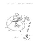 ACTIVE IMPLANTABLE MEDICAL SYSTEM HAVING EMI SHIELDED LEAD diagram and image