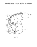 ACTIVE IMPLANTABLE MEDICAL SYSTEM HAVING EMI SHIELDED LEAD diagram and image