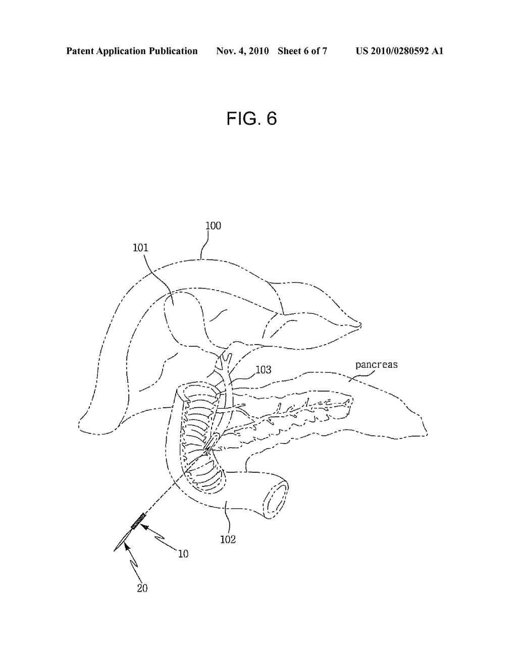 DRAWSTRING FOR REMOVAL OF STENT - diagram, schematic, and image 07