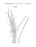 IMPLANT DELIVERY DEVICE diagram and image
