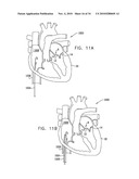 DEPLOYMENT TECHNIQUES FOR ANNULOPLASTY RING diagram and image