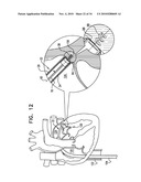 DEPLOYMENT TECHNIQUES FOR ANNULOPLASTY RING diagram and image