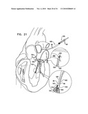 DEPLOYMENT TECHNIQUES FOR ANNULOPLASTY RING diagram and image