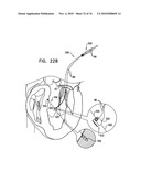 DEPLOYMENT TECHNIQUES FOR ANNULOPLASTY RING diagram and image