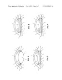 ADJUSTABLE ACCOMMODATING INTRAOCULAR LENS AND POSITIONING MEANS diagram and image