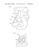 NASAL IMPLANT INTRODUCED THROUGH AN INJECTION TECHNIQUE diagram and image