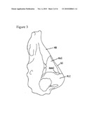 NASAL IMPLANT INTRODUCED THROUGH AN INJECTION TECHNIQUE diagram and image