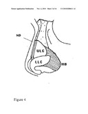 NASAL IMPLANT INTRODUCED THROUGH AN INJECTION TECHNIQUE diagram and image