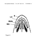 NASAL IMPLANT INTRODUCED THROUGH AN INJECTION TECHNIQUE diagram and image