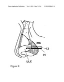 NASAL IMPLANT INTRODUCED THROUGH AN INJECTION TECHNIQUE diagram and image