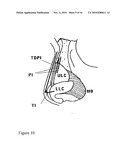 NASAL IMPLANT INTRODUCED THROUGH AN INJECTION TECHNIQUE diagram and image