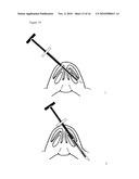 NASAL IMPLANT INTRODUCED THROUGH AN INJECTION TECHNIQUE diagram and image