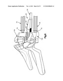 TRIAL IMPLANT ASSEMBLY diagram and image