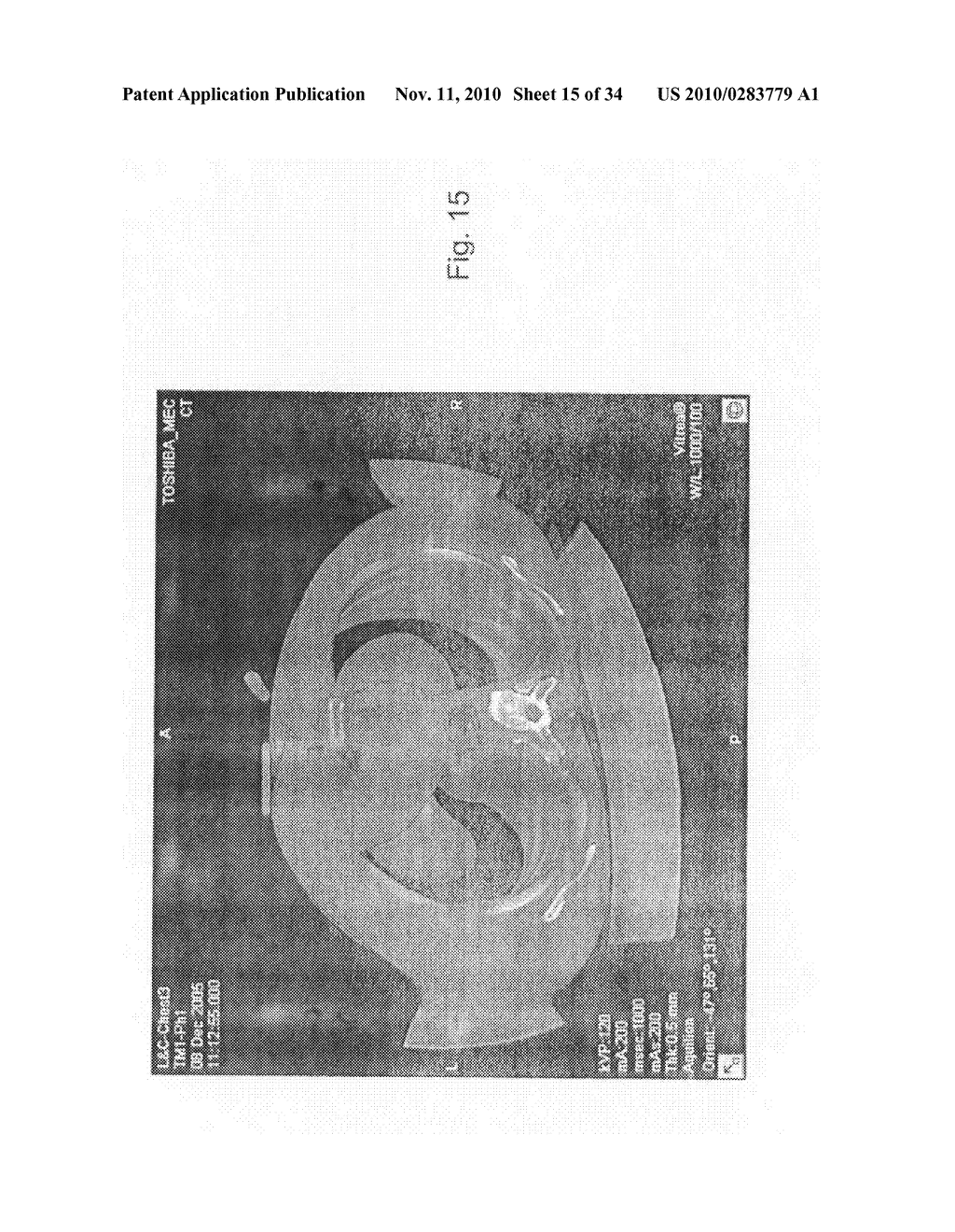 METHOD AND SYSTEM FOR TOMOGRAPHIC RECONSTRUCTION IN MEDICAL IMAGING USING THE CIRCLE AND LINE TRAJECTORY - diagram, schematic, and image 16