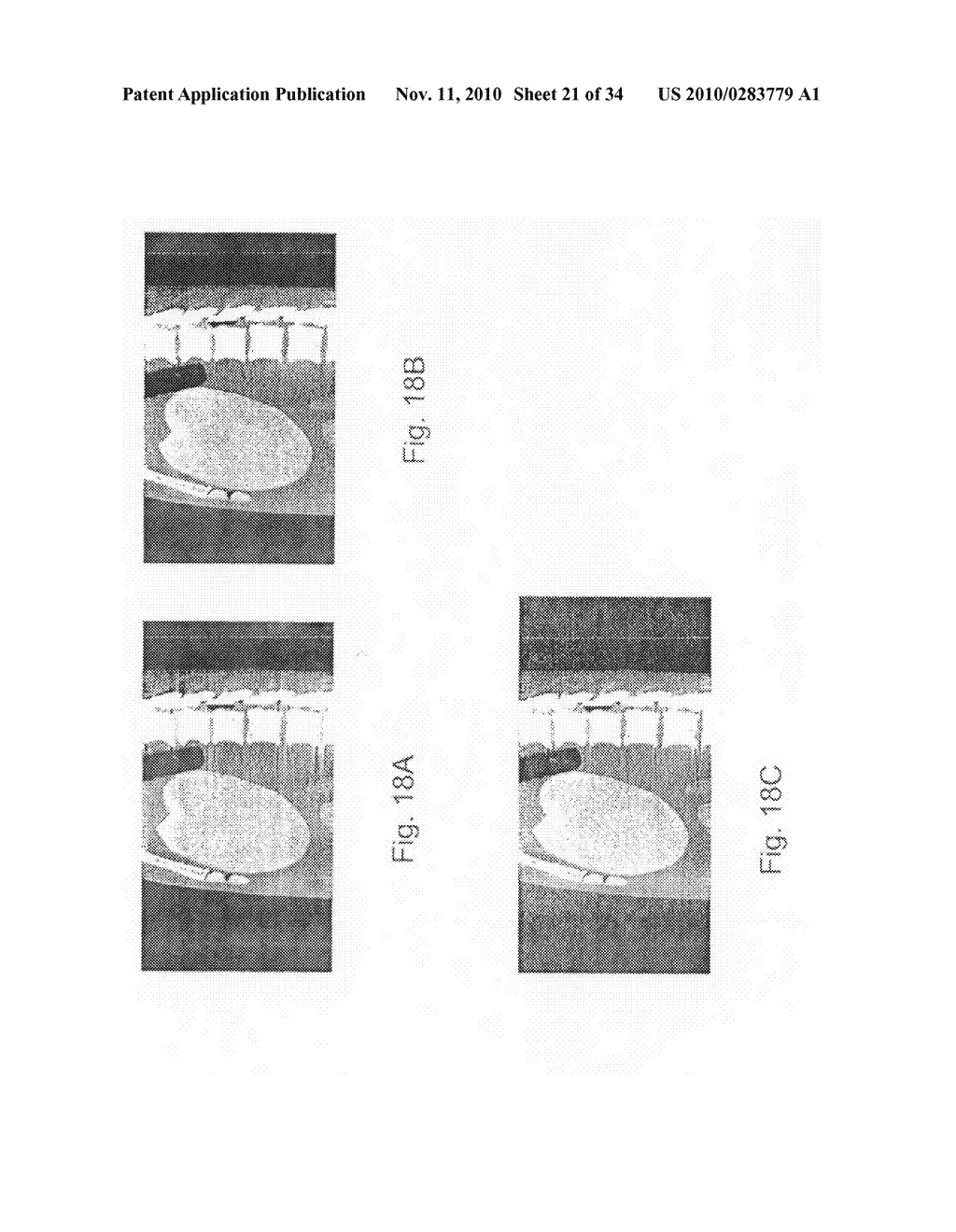 METHOD AND SYSTEM FOR TOMOGRAPHIC RECONSTRUCTION IN MEDICAL IMAGING USING THE CIRCLE AND LINE TRAJECTORY - diagram, schematic, and image 22