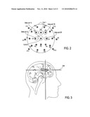 TRANSCRANIAL MAGNETIC STIMULATION FIELD SHAPING diagram and image