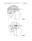 TRANSCRANIAL MAGNETIC STIMULATION FIELD SHAPING diagram and image