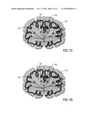 TRANSCRANIAL MAGNETIC STIMULATION FIELD SHAPING diagram and image