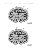 TRANSCRANIAL MAGNETIC STIMULATION FIELD SHAPING diagram and image