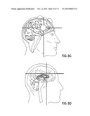 TRANSCRANIAL MAGNETIC STIMULATION FIELD SHAPING diagram and image