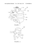 PEDICLE GUIDED RETRACTOR SYSTEM diagram and image