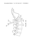 PEDICLE GUIDED RETRACTOR SYSTEM diagram and image