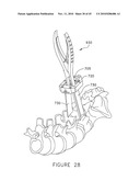 PEDICLE GUIDED RETRACTOR SYSTEM diagram and image