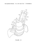 PEDICLE GUIDED RETRACTOR SYSTEM diagram and image