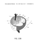 Systems and Methods for Prostate Treatment diagram and image