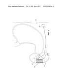 Radially Expandable Gastrointestinal Stimulation Device diagram and image