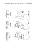 System For Implanting a Valve Prosthesis diagram and image