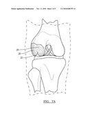 Stable Cartilage Defect Repair Plug diagram and image